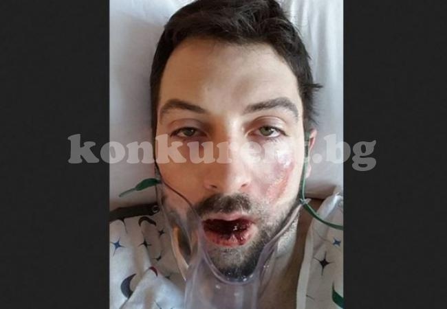 Електронна цигара се взриви в устата на мъж, изби му седем зъба (СНИМКИ 18+)