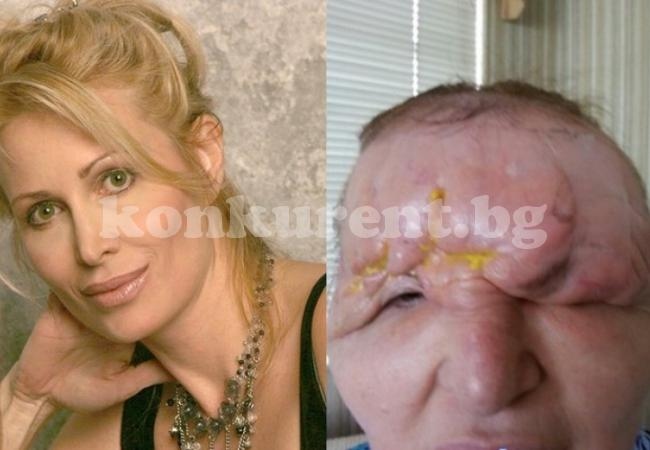 Жена се подложи на процедури с ботокс заради бръчки, но последствията бяха напълно потресаващи (СНИМКИ/ВИДЕО 18+)