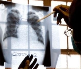 Преглеждат безплатно за туберкулоза в Монтана