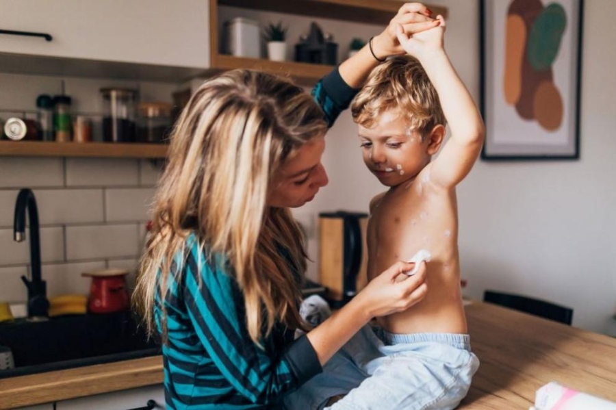 114 са заболелите от морбили във Врачанско, 149 са в цялата страна